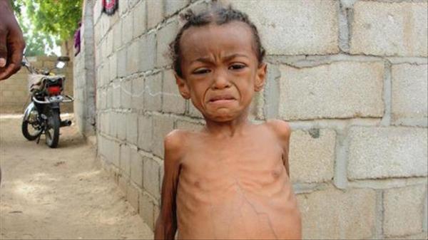 تقرير أممي: 36 % من اليمنيين يعانون من سوء التغذية