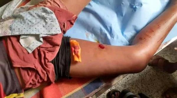 إصابة طفل برصاص المليشيات اثناء خروجه من مدرسته بلحج