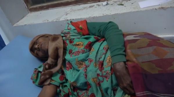 إصابة نازحة برصاص مليشيات الحوثي بمنطقة المتينة